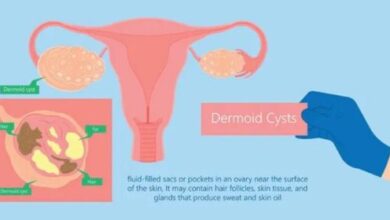dermoid cyst
